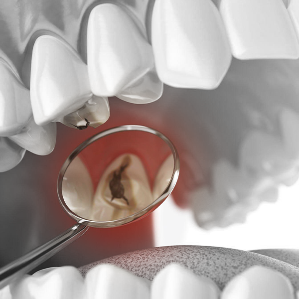Orasore-Dental-Tablet-Dental-Cavities