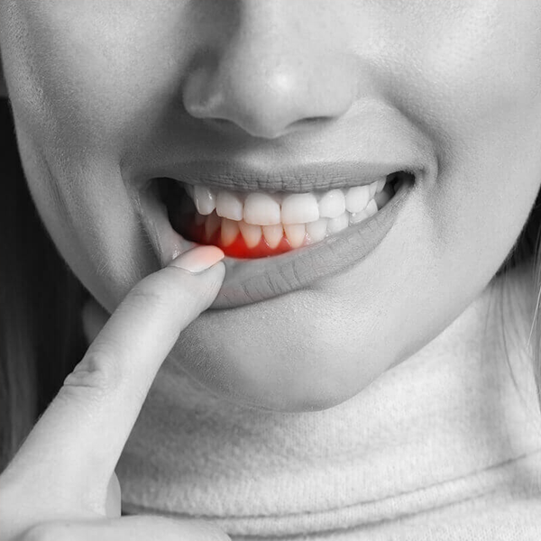 Orasore-Dental-Tablet-Pain-Due-To-Dentures