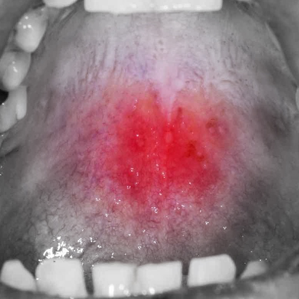 Orasore-Mouth-Ulcer-Gel-Ulcers-On-Palate