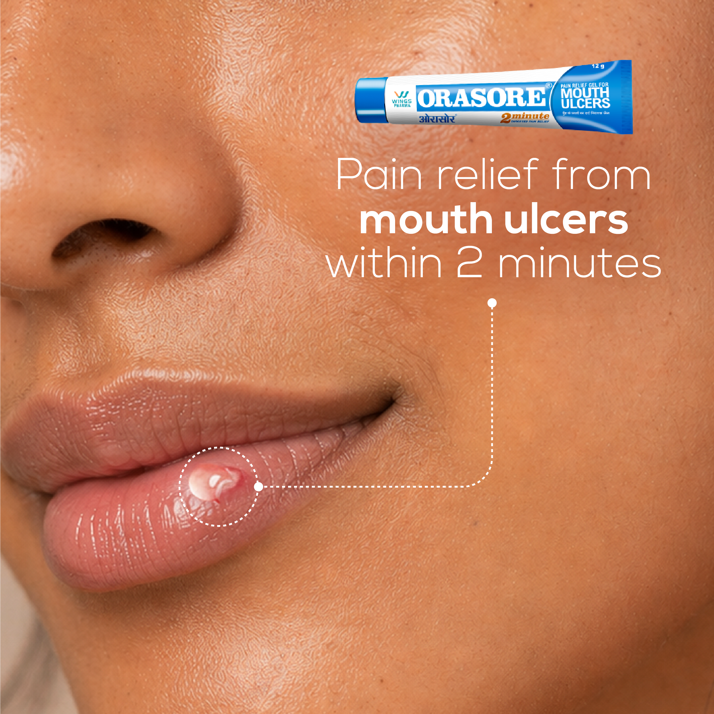 Orasore-Mouth-Ulcer-Gel