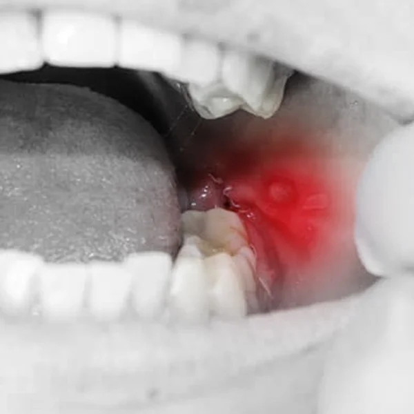 Orasore-mouth-ulcer-tablet-Ulcers-On-Inner-Side-Of-Cheek