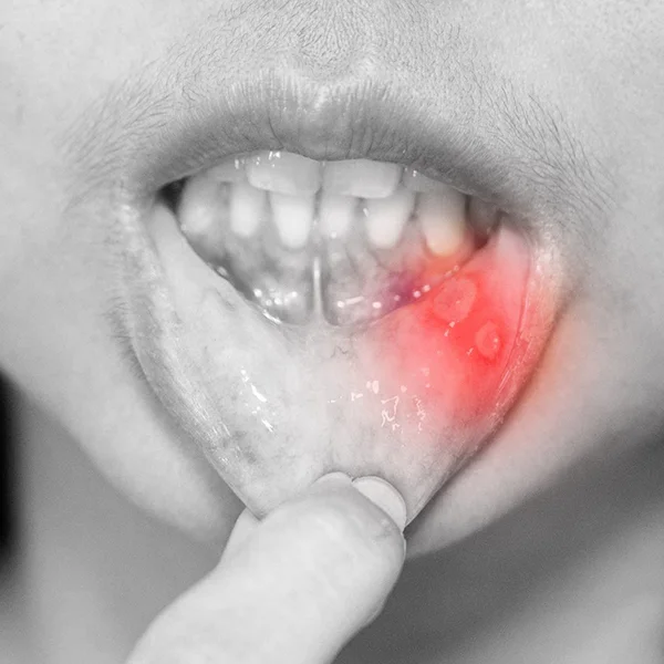 Orasore-mouth-ulcer-tablet-Ulcers-On-Inner-Lips