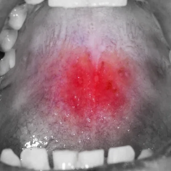 Orasore-mouth-ulcer-tablet-Ulcers-On-Palate