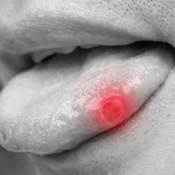 Orasore-mouth-ulcer-tablet-Ulcers-On-Tongue