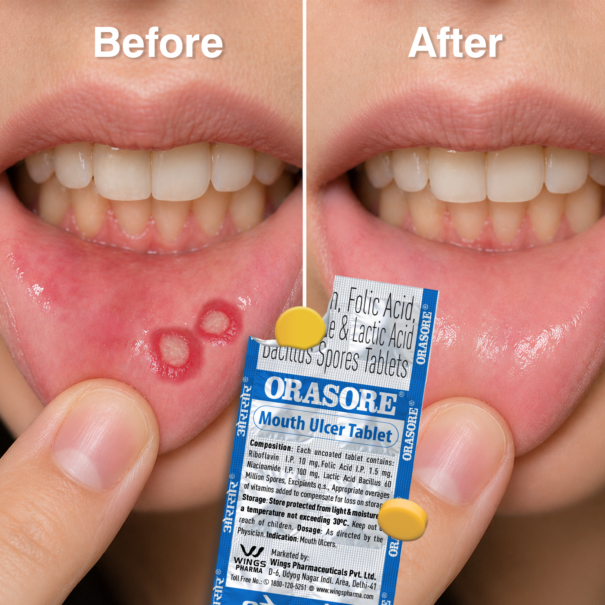 Orasore Mouth Ulcer Tablet