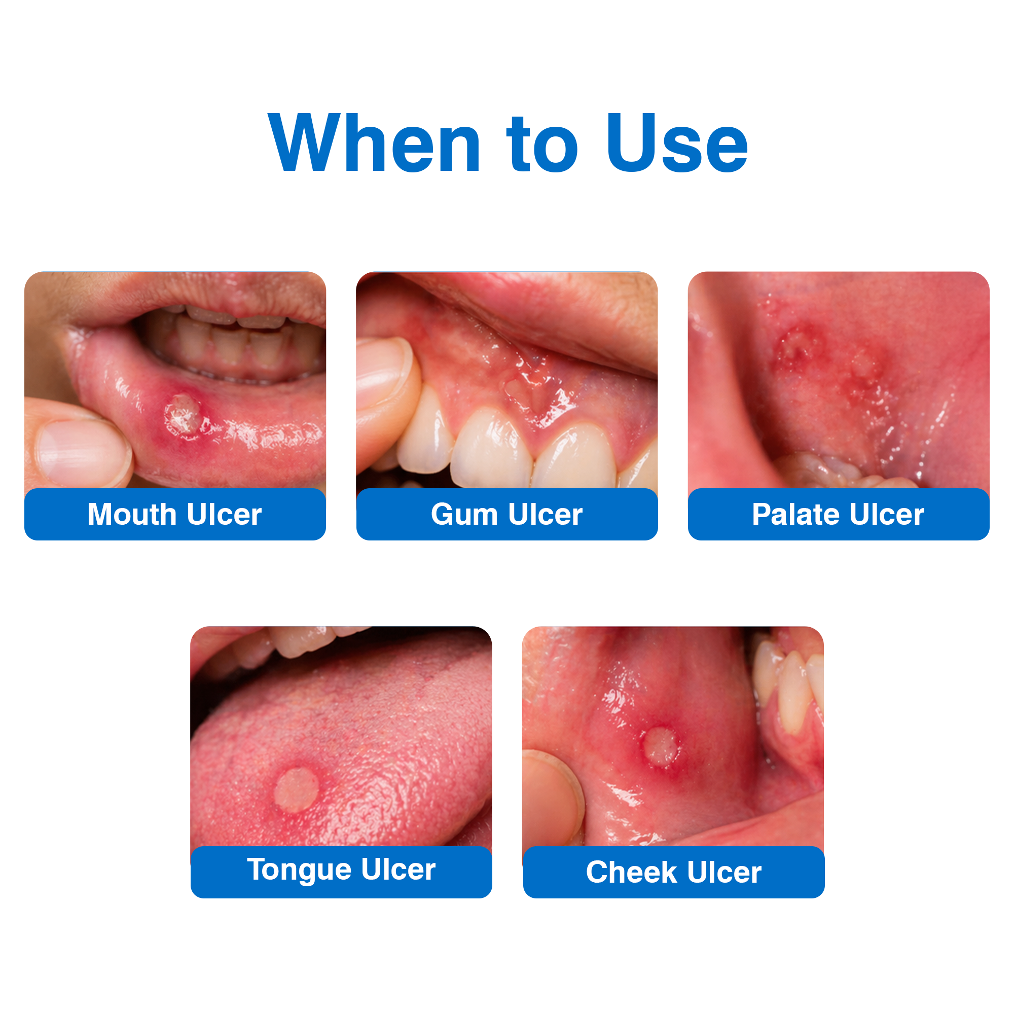 Orasore Mouth Ulcer Tablet